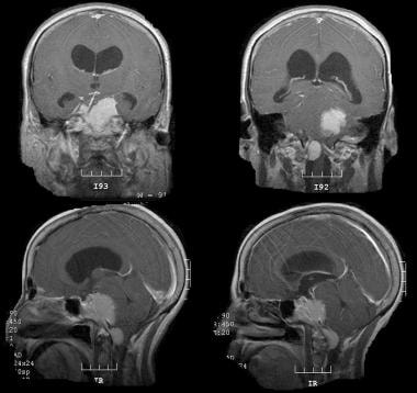 Multiple skull base meningiomas. Contrast-enhanced