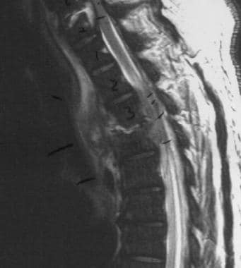 Spinal epidural abscess with cord edema and compre