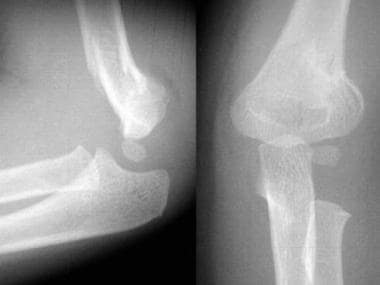 supracondylar fracture of humerus in adults