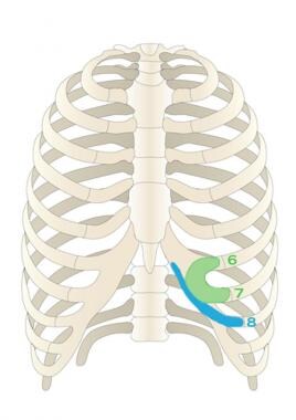 Very small (1.0-1.5 in.) incision is made on skin,