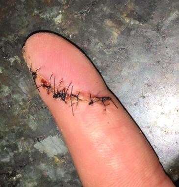 cut fingers with staples