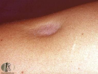 Localized lipoatrophy from a steroid injection. Co