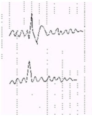 Schematic of an interictal epileptiform discharge 