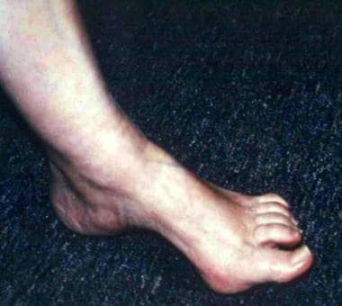 Pes cavus deformity can be associated with many co