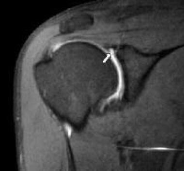 MRI arthrography can help to identify labral tears