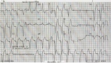 Intermittent periods of ventricular capture. 