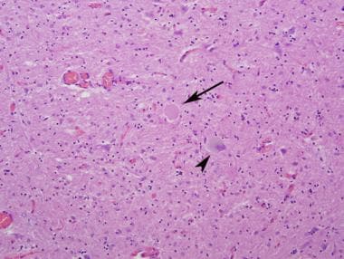 Pathology of motor neuron disorders. Amyotrophic l