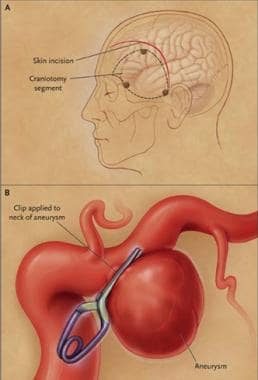 Craniotomy and clipping of aneurysm. Skin incision