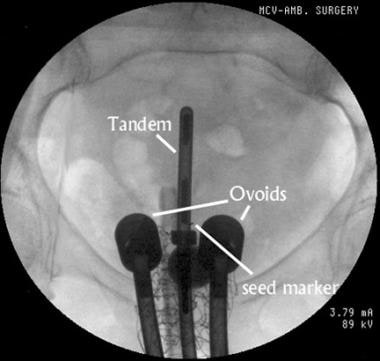Anteroposterior view of an intrauterine tandem and
