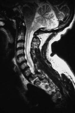 T2-weighted sagittal magnetic resonance image thro