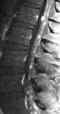 Sagittal T1-weighted postcontrast image of the lum