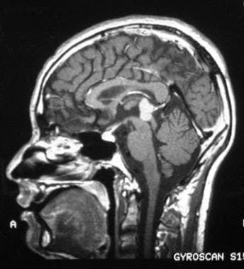 Pineal germinoma in a 19-year-old man. Sagittal T1