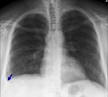 Posteroanterior chest radiograph in a 42-year-old 