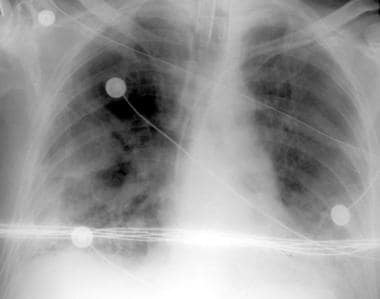 Portable chest radiograph in a patient with acute 