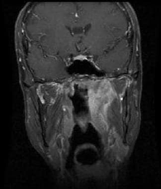 Coronal gadolinium-enhanced T1-weighted MRI shows 