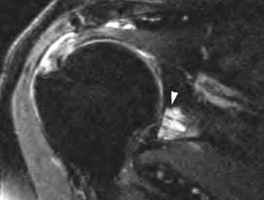 Oblique coronal T2-weighted fat-suppression image 