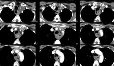 Axial post-contrast CT images through the neck sho