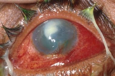 Severe chemical injury with early corneal neovascu