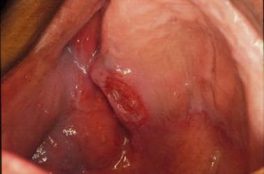 Squamous cell carcinoma of the sinus that penetrat