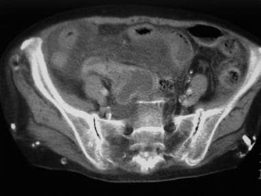 CT scan of a 76-year-old woman with severe abdomin