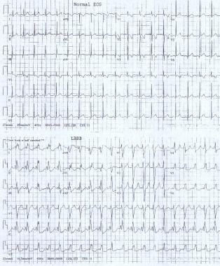 These electrocardiograms show a normal sinus rhyth