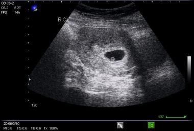 Transverse picture of gestational sac with yolk sa