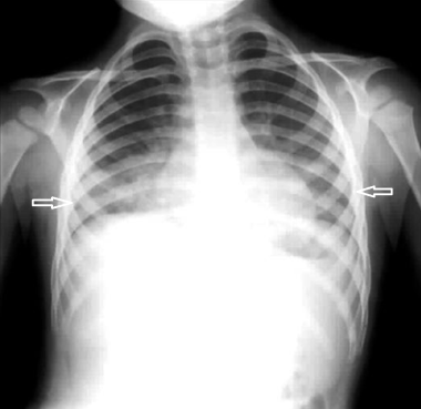 This patient had bilateral paraffin pneumonitis (c