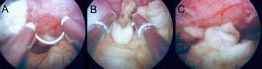 Myomectomy with the Versapoint operative hysterosc