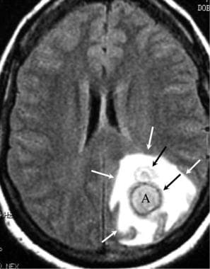 Brain abscess. Axial fluid-attenuated inversion re