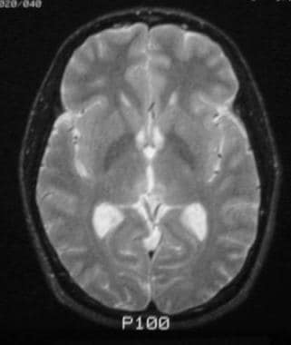 Pineal germinoma in a 30-year-old man. Axial T2-we