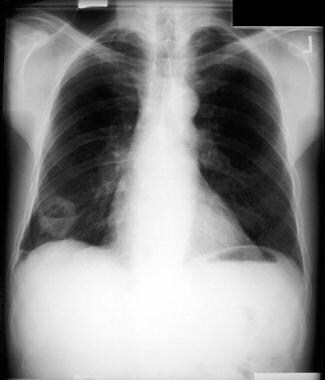 Non–small cell lung cancer. A cavitating right low