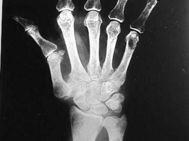 Posteroanterior radiograph of the wrist. Note the 
