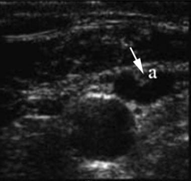 Ultrasound-guided internal jugular vein (IJV) punc