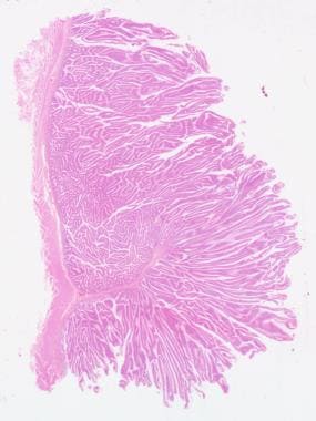 Villous adenoma, low-power view. Courtesy of Georg