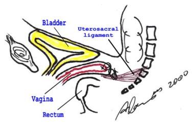 Enterocele and massive vaginal eversion. Depiction