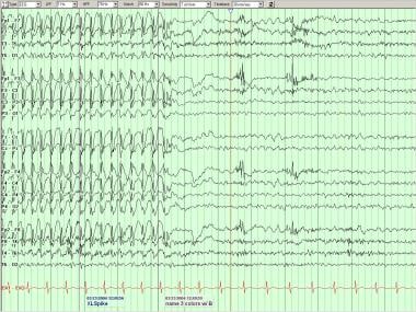Generalized spike-wave complexes in a patient with