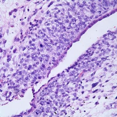 A higher-power image shows nuclear atypia and mito