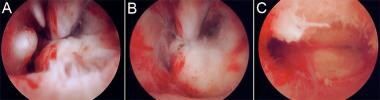 Myomectomy and polypectomy with the Truclear (Smit