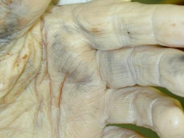 Soot on the palmar surface of a hand, likely from