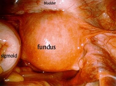 Laparoscopic view of the pelvis during application