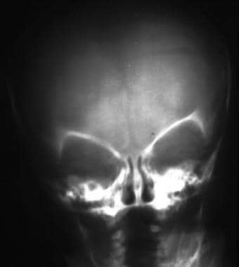 Frontal skull radiograph demonstrates a left-sided
