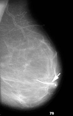 A 42-year-old woman with serous discharge from her