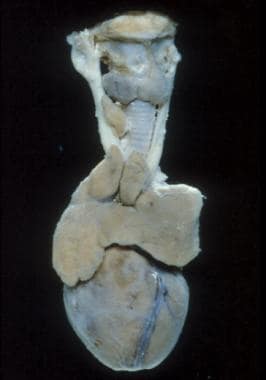 Fairly large thymus in an infant. 