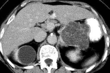 Serous cystadenoma on a contrast-enhanced CT scan.