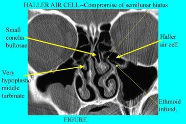 CT scan, nasal cavity. Large Haller air cell clear