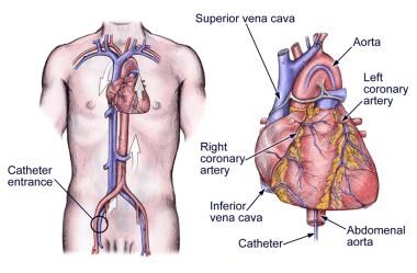 The heart catheterization. 