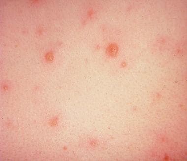 Chickenpox In Babies Nhs