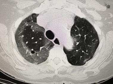 CT scan of a 79-year-old woman with proven SARS-co