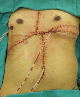 Soft tissue closure of defect with right-sided pec