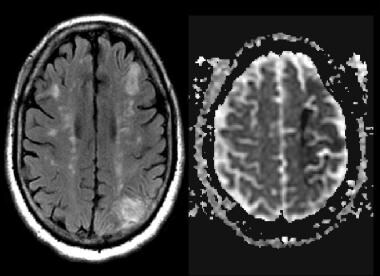 Magnetic resonance imaging (MRI) scan was obtained